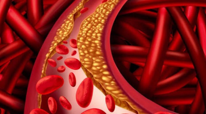 Türkiye’de Ailesel Hiperkolesterolemi dünya ortalamasının iki katı