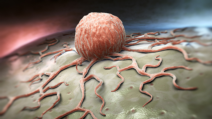 En Sık Görülen Kanserler